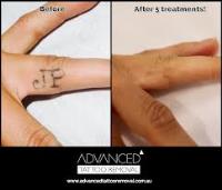 Advanced Tattoo Removal image 5